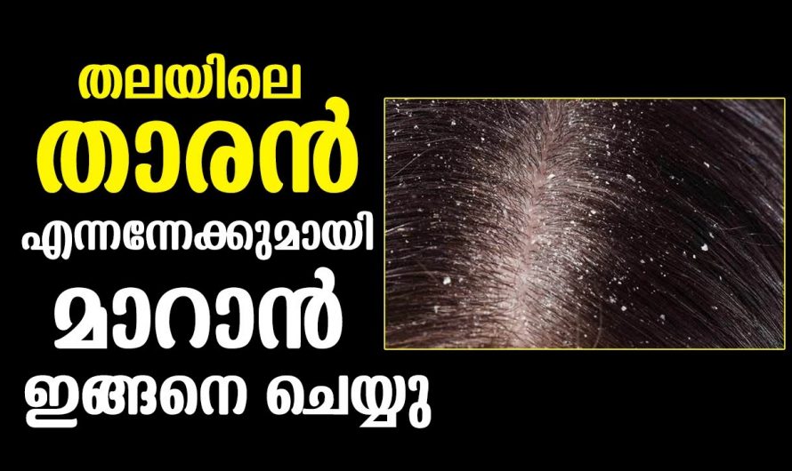 തലമുടിയിലെ താരൻ പരിഹരിച്ചു  മുടിയെ സംരക്ഷിക്കാൻ..