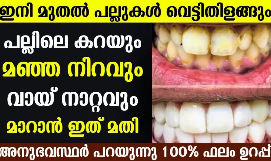 പല്ലുകളിലെ മോണ രോഗം  വായനാറ്റം മഞ്ഞനിറം എന്നിവ പരിഹരിക്കാൻ..