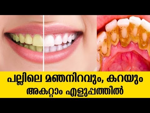 പല്ലുകളിലെ മഞ്ഞ നിറവും കറയും പരിഹരിച്ച് ആത്മവിശ്വാസത്തോടെ പുഞ്ചിരിക്കാൻ…