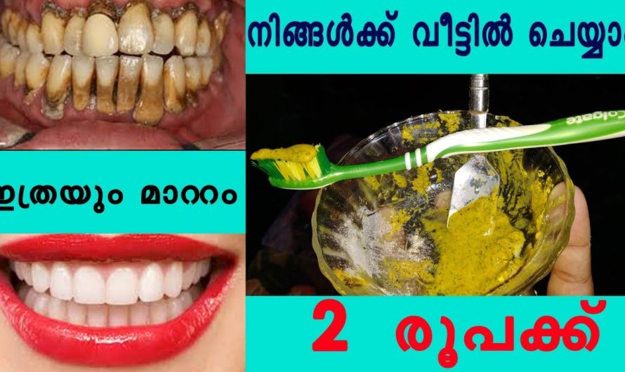 പല്ലുകളിലെ എല്ലാവിധത്തിലുള്ള പ്രശ്നങ്ങൾക്കും കിടിലൻ പരിഹാരം…