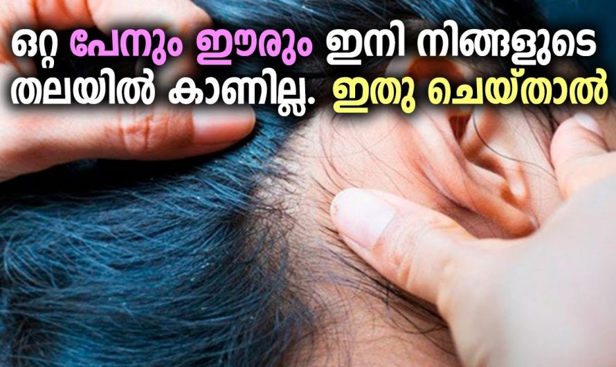 തലമുടിയിലെ പേൻ  ഈരും പരിഹരിച്ച് മുടിയെ സംരക്ഷിക്കാൻ…