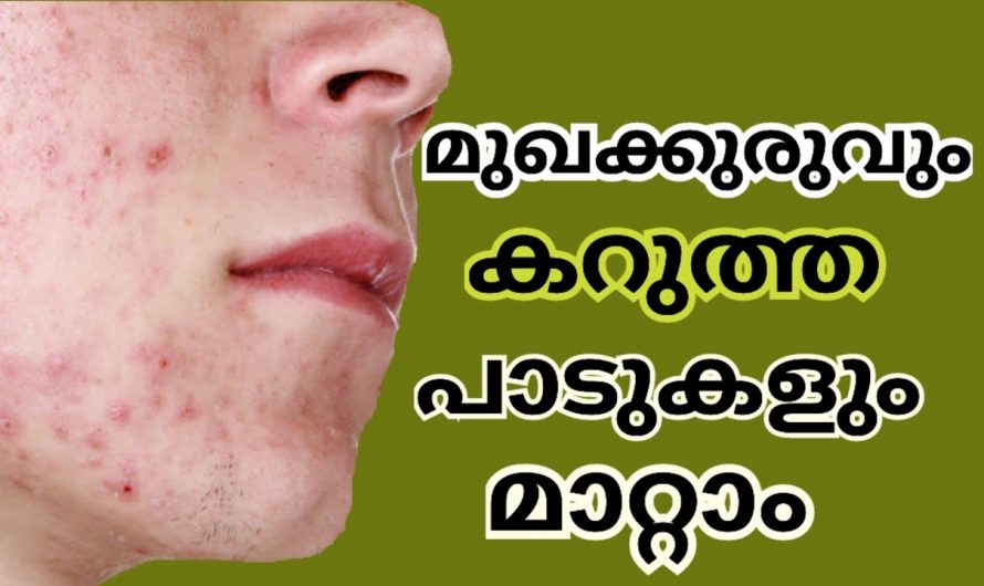 മുഖക്കുരുവും  മുഖക്കുരു വന്ന കറുത്ത പാടുകളും എളുപ്പത്തിൽ പരിഹരിക്കാൻ.