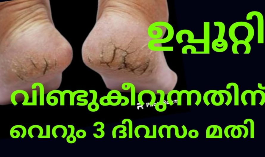 കാൽപാദങ്ങളിലെ വിണ്ടുകീറൽ നീക്കം ചെയ്ത് കാൽപാദങ്ങളെ സംരക്ഷിക്കാൻ..  | Cracked Heels Treatment Malayalam