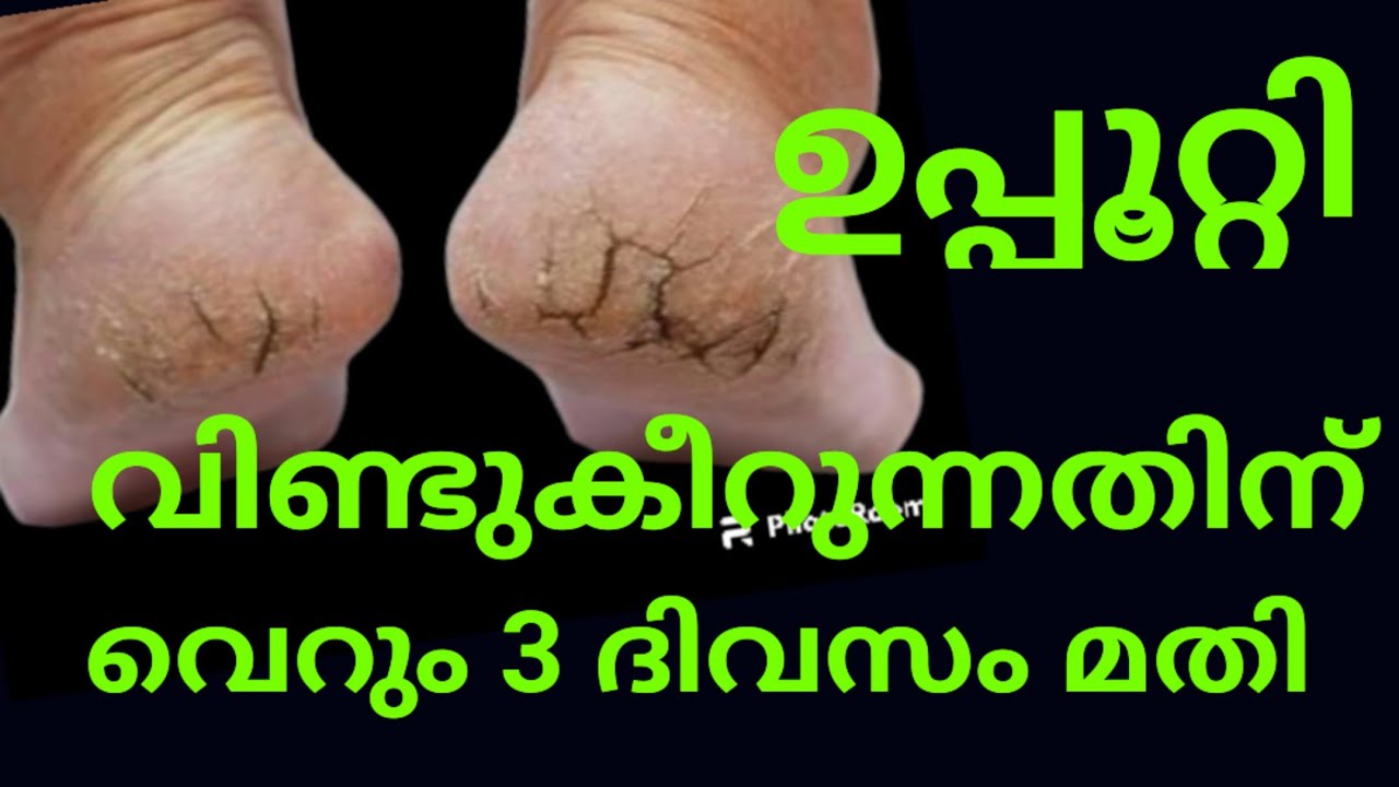 Cracked Heels Treatment Malayalam