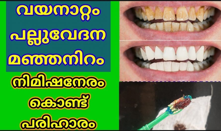 പാർശ്വഫലങ്ങൾ ഇല്ലാതെ പല്ലുകളെ സംരക്ഷിക്കാൻ…