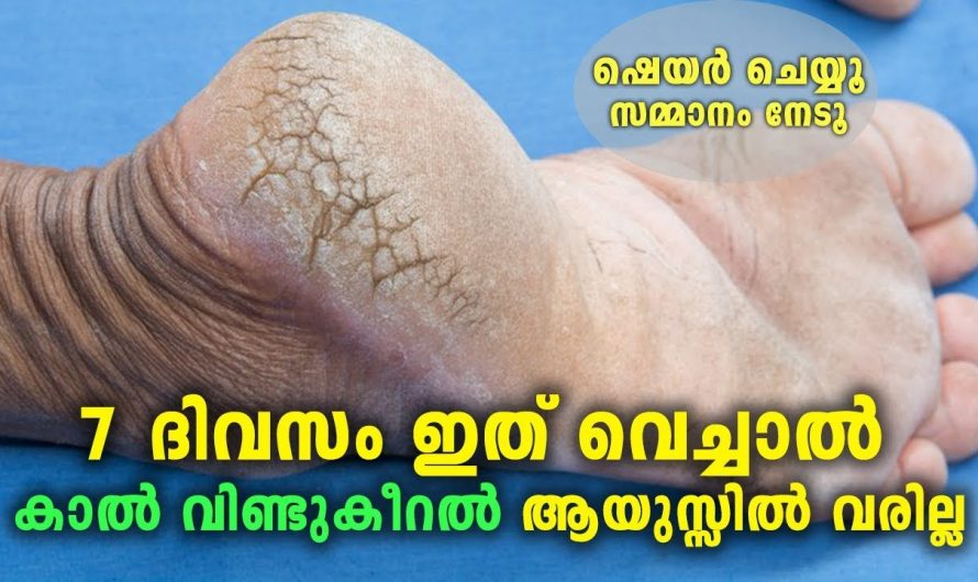 ഉപ്പുറ്റി വീണ്ടുകീറുന്ന അവസ്ഥയ്ക്ക് ഉടനടി പരിഹാരം..