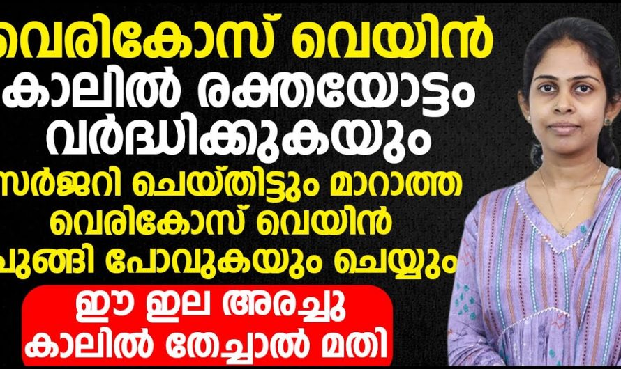 വെരിക്കോസ് വെയിൻ പരിഹരിച്ച് ആരോഗ്യത്തെ സംരക്ഷിക്കാൻ.