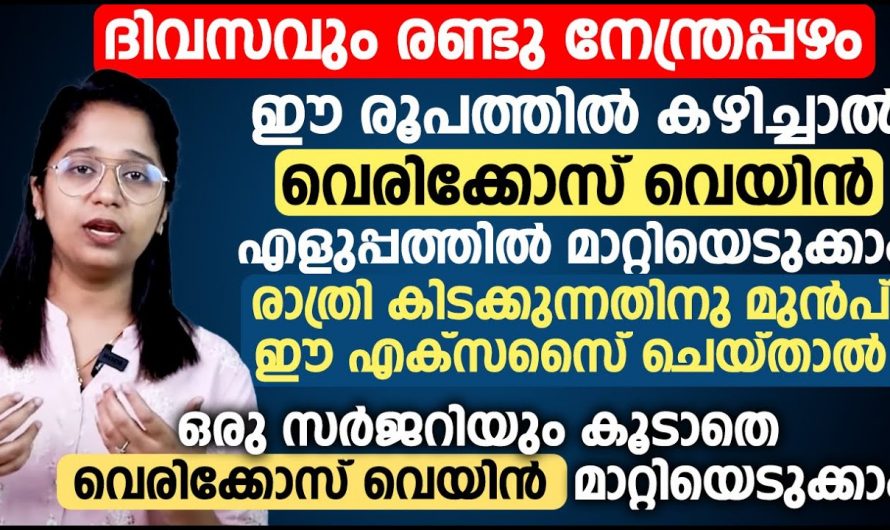 വെരിക്കോസ് വെയിന്റെ കാരണങ്ങളും ലക്ഷണങ്ങളും പരിഹാരമാർഗ്ഗങ്ങളും..