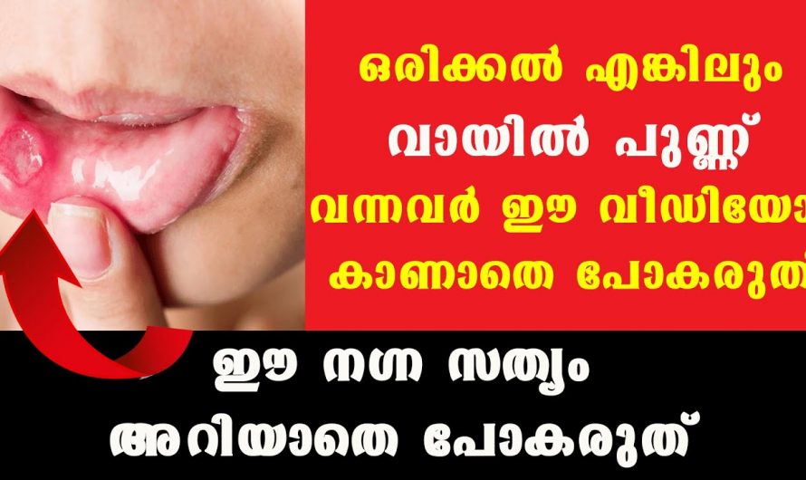 വായയിൽ പുണ്ണ് വരുന്നതിന് കാരണങ്ങളും പരിഹാരമാർഗങ്ങളും..