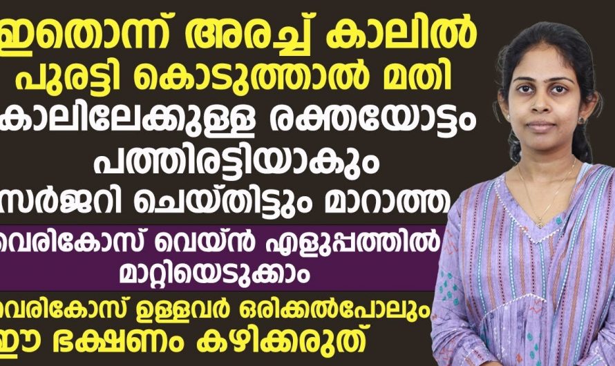 ഇതു പുരട്ടിയാൽ സർജറി ചെയ്തിട്ടും മാറാത്ത വെരിക്കോസ് വെയിൻ മാറും.