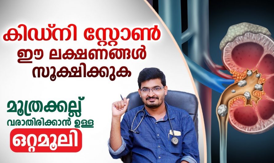 കിഡ്നി സ്റ്റോൺ മൂത്രത്തിൽ കല്ല് എങ്ങനെ പരിഹരിക്കാം…