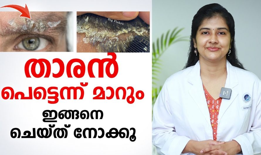 താരൻ  ഉണ്ടാകുന്നതിന്റെ കാരണങ്ങളും പരിഹാരമാർഗങ്ങളും..