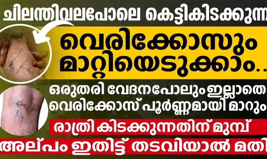 വെരിക്കോസ് വെയിൻ ഉണ്ടാകുന്നതിന്റെ കാരണങ്ങളും പരിഹാരമാർഗങ്ങളും..