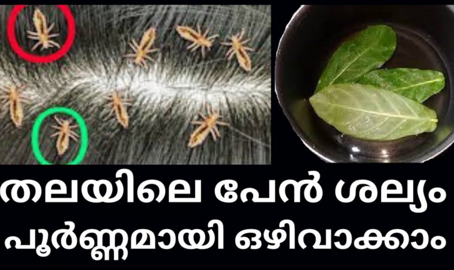 പേൻ ശല്യം സഹിക്കാൻ സാധിക്കാത്ത ആളാണോ നിങ്ങൾ എങ്കിൽ ഈ കാര്യം ചെയ്തോളൂ