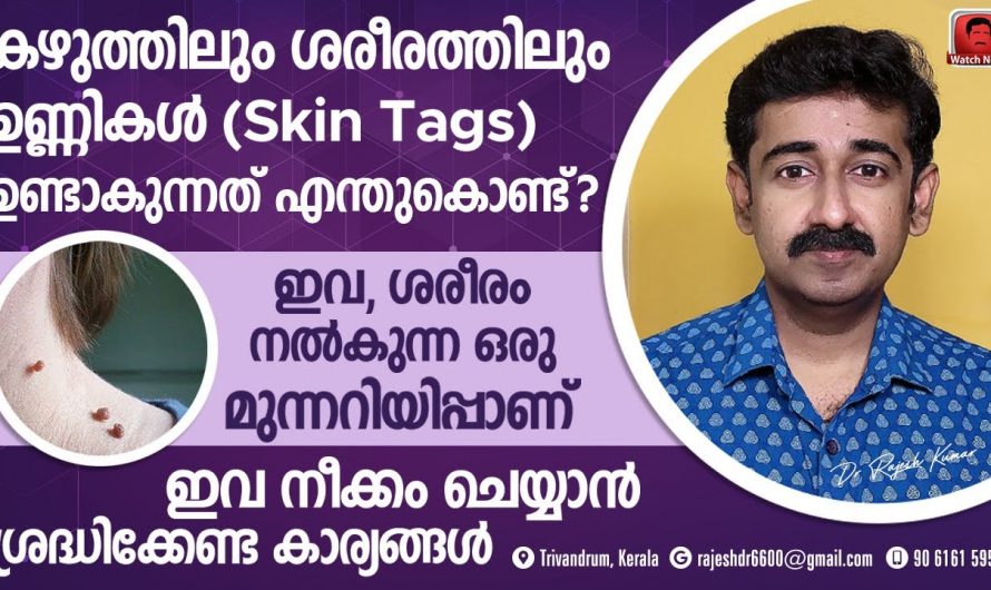 സ്കിൻ ടാഗുകൾ കേവലം ഒരു സൗന്ദര്യ പ്രശ്നം മാത്രമാണോ? എന്തെങ്കിലും ആരോഗ്യ പ്രശ്നങ്ങൾ ഉണ്ടാകുമോ