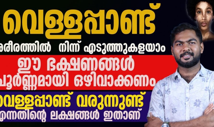 വെള്ളപ്പാണ്ട്   ത്വക്കിന്  ഇങ്ങനെ ബാധിക്കുന്ന മനസ്സിലാക്കാം..😱