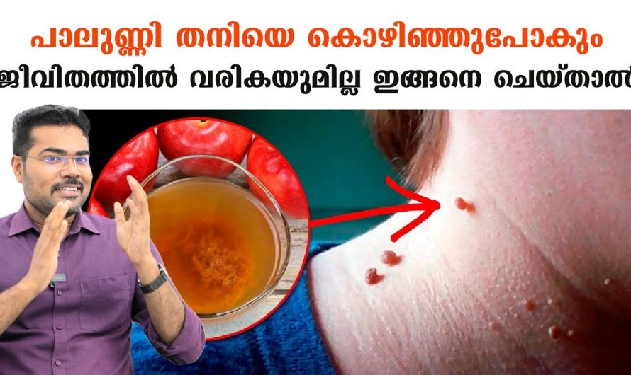 സൗന്ദര്യത്തിന് വെല്ലുവിളിയാകുന്ന  പാലുണ്ണി നീക്കം ചെയ്യാൻ.😱