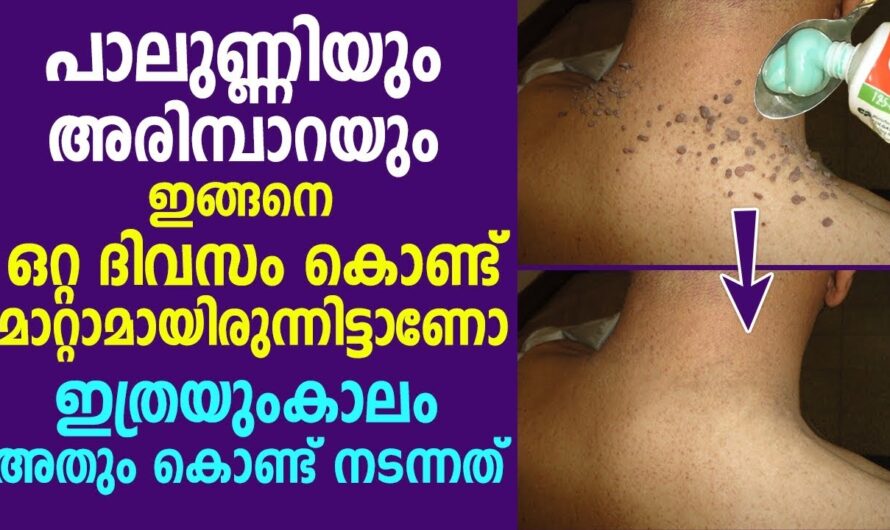 ശരീരത്തിലെ പാലുണ്ണിയും അരിമ്പാറയും എളുപ്പത്തിൽ പരിഹരിക്കാൻ.